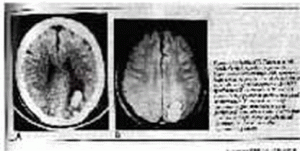 MRI and CAT scan of ECT damage